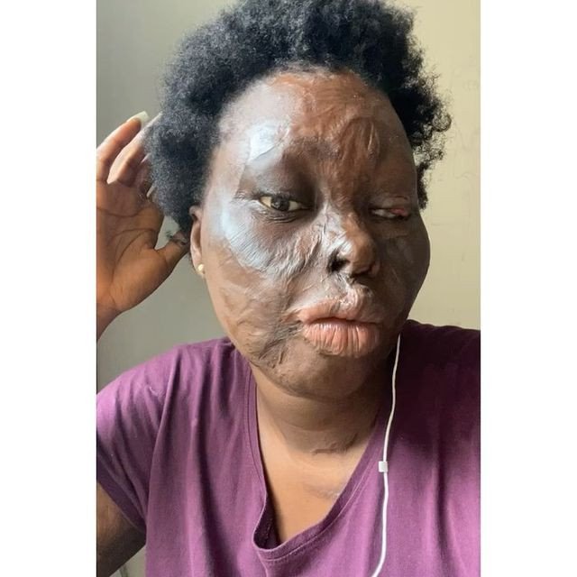 Burn Survivor, Francess Obanye Marks 17 Years of Surviving Acid Attack | Daily Report Nigeria