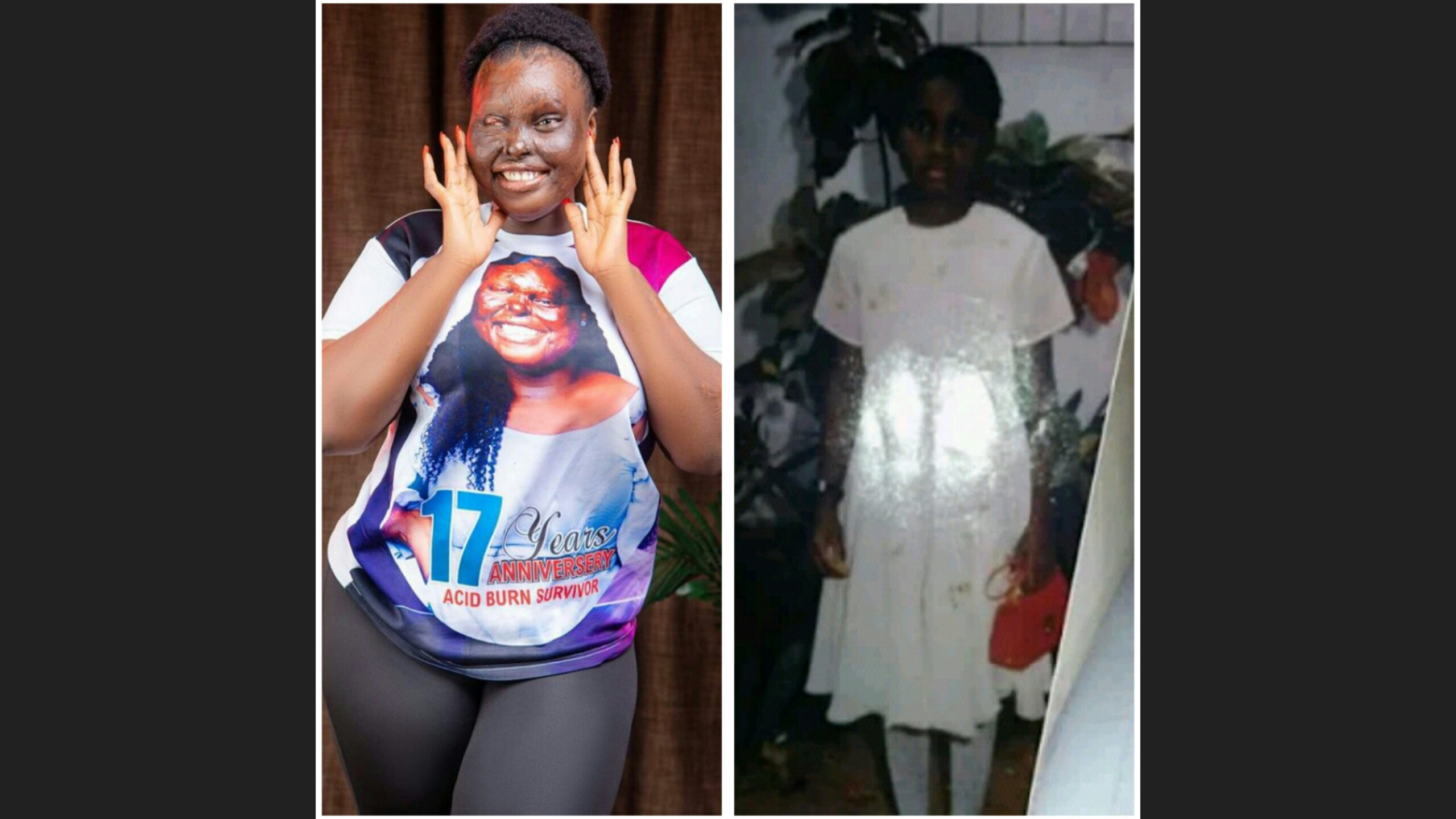 Burn Survivor, Francess Obanye Marks 17 Years of Surviving Acid Attack | Daily Report Nigeria