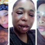 Lady Who Often Show Off Her Boyfriend Shares Photos of Her Bruised Face After Alleged Assault | Daily Report Nigeria