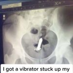 Lady Narrates How Vibrator Got Stucked In Her Butt Needed Surgery To Remove It<br> | Daily Report Nigeria