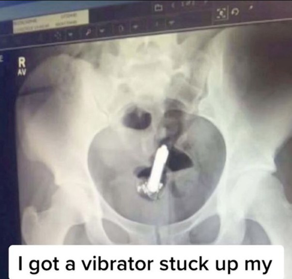 Lady Narrates How Vibrator Got Stucked In Her Butt Needed Surgery To Remove It<br> | Daily Report Nigeria