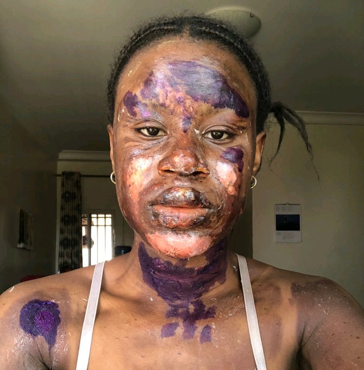 Gas Explosion Survivor Shares Transformation Photos | Daily Report Nigeria