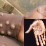 Monkeypox Can Be Transmitted Through Sex, Says NCDC | Daily Report Nigeria