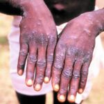 Nigerians Should Be Blamed For Monkeypox Outbreak - NCDC | Daily Report Nigeria