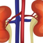 11 Ways to Prevent Kidney Failure