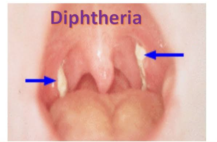 Diphtheria Outbreak Affects 13 LGAs In Kano | Daily Report Nigeria