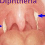 26 Die From Diphtheria In Yobe | Daily Report Nigeria