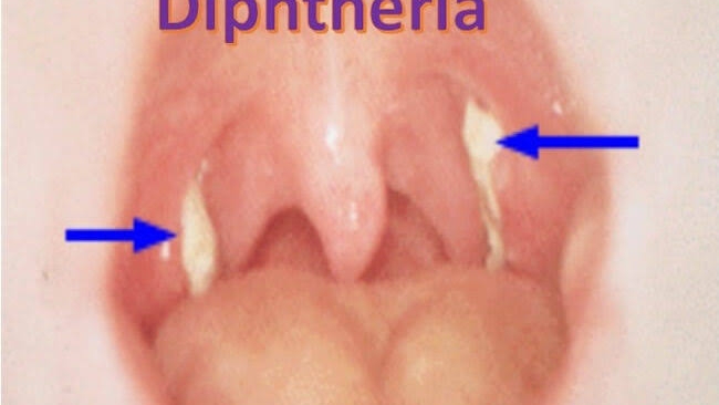 26 Die From Diphtheria In Yobe | Daily Report Nigeria