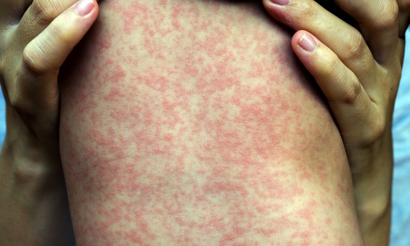 Measles Outbreak Kills 42 in Adamawa | Daily Report Nigeria
