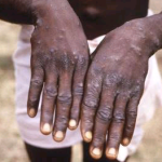 Mpox Outbreak Spreads: WHO Sounds Alarm as Cases Reach 17,000 | Daily Report Nigeria