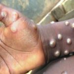 Africa to Declare Public Health Emergency Over Mpox | Daily Report Nigeria