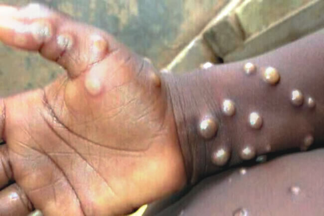 Africa to Declare Public Health Emergency Over Mpox | Daily Report Nigeria