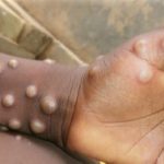 Global Alarm: WHO Unveils $135m Battle Plan to Tame Mpox Outbreak | Daily Report Nigeria