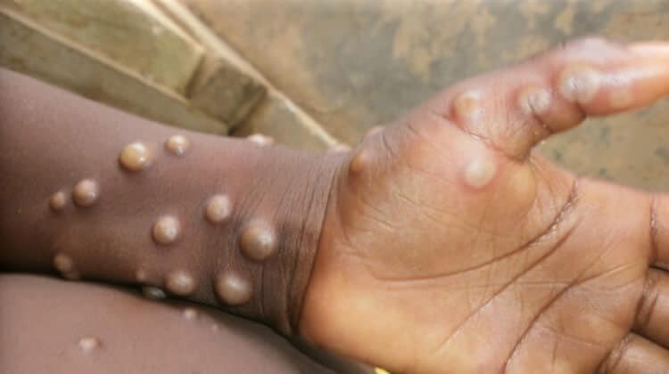 Nigeria Records 40 Cases of Mpox | Daily Report Nigeria