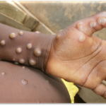 Mpox: India Confirms First Deadlier Case | Daily Report Nigeria