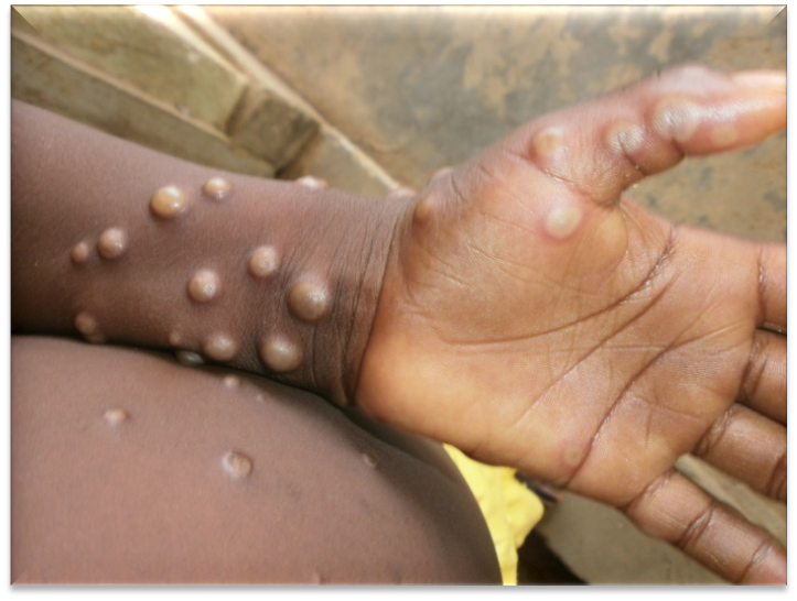 Mpox: India Confirms First Deadlier Case | Daily Report Nigeria